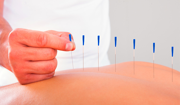 La acupuntura: una terapia que va al centro del dolor